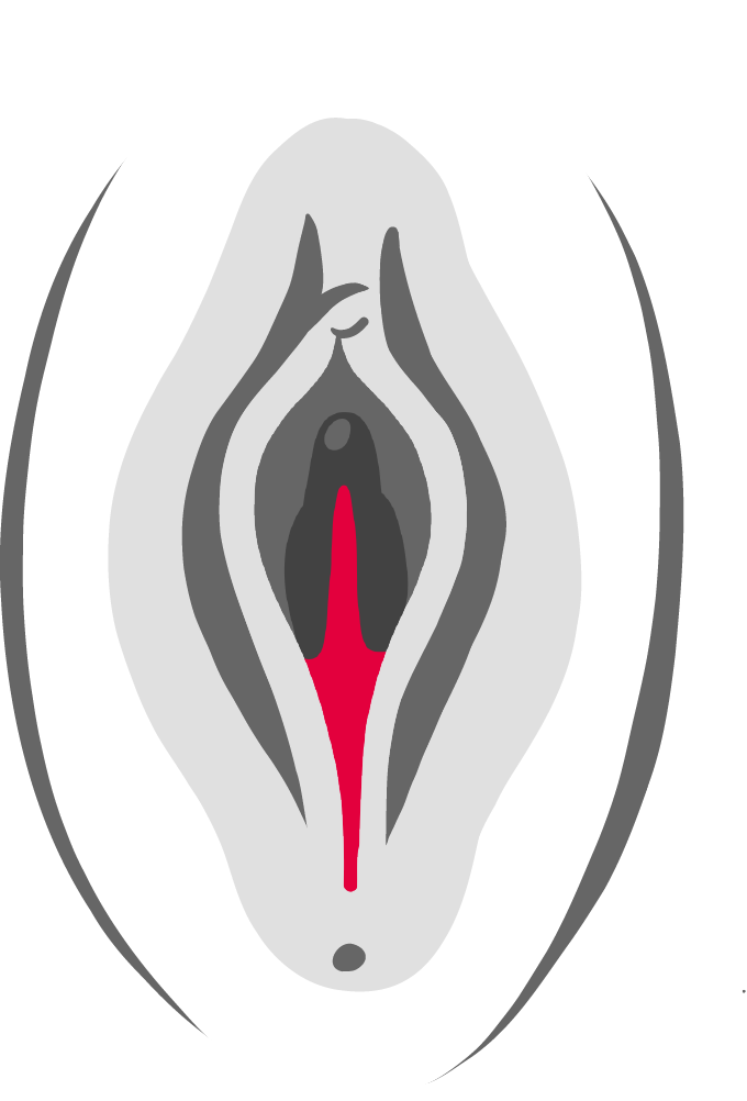 Vaginalstraffung